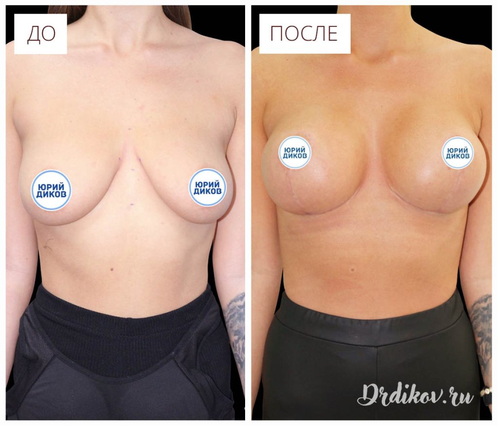 удаление и восстановление груди в одну операцию фото 16